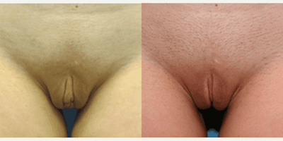 Case 10031 - Woman treated with Labiaplasty