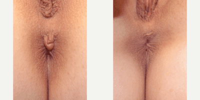 Case 10034 - Woman treated with Labiaplasty
