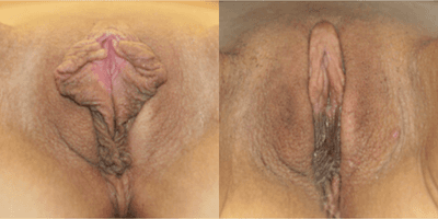 Case 10036 - Woman treated with Labiaplasty