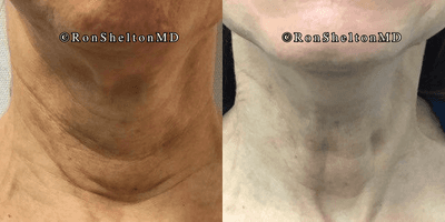 Case 10193 - 65-74 year old woman treated with Ultherapy, Sofwave, Neck Lift, Skin Tightening