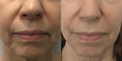 Case 10194 - 65-74 year old woman treated with Sofwave, Ultherapy, Skin Tightening