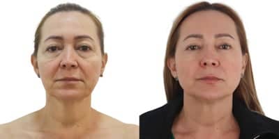 Case 10196 - 45-54 year old woman treated with Ultherapy