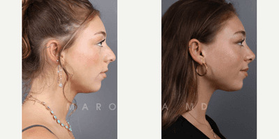 Case 10382 - Woman treated with Rhinoplasty, Septoplasty