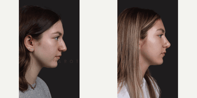Case 10386 - Woman treated with Rhinoplasty, Septoplasty