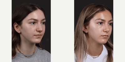 Case 10387 - Woman treated with Rhinoplasty, Septoplasty