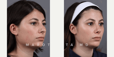 Case 10388 - Woman treated with Septoplasty