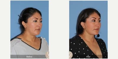Case 10500 - 47 year old woman treated with Deep Plane Facelift, Neck Lift, Brow Lift, Buccal Fat Removal, MACS Facelift