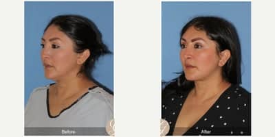 Case 10501 - 47 year old woman treated with Deep Plane Facelift, Neck Lift, Brow Lift, Buccal Fat Removal, MACS Facelift