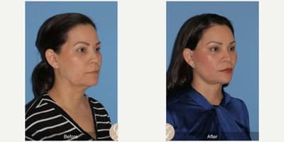 Case 10508 - 51 year old woman treated with Deep Plane Facelift, Facelift, Neck Lift, Brow Lift, Facial Fat Transfer, MACS Facelift