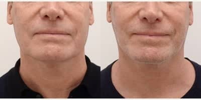 Case 10561 - 45-54 year old man treated with Facelift, MACS Facelift