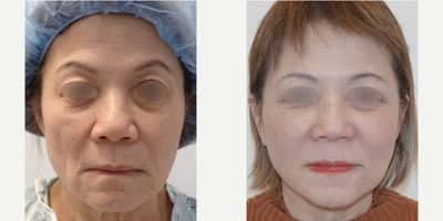 Case 10562 - 55-64 year old woman treated with Facelift, MACS Facelift, Eyelid Surgery