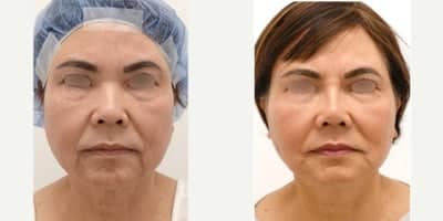 Case 10563 - 55-64 year old woman treated with MACS Facelift, Eyelid Surgery, Buccal Fat Removal, Rhinoplasty
