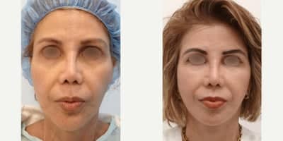 Case 10564 - 65-74 year old woman treated with Facelift, MACS Facelift