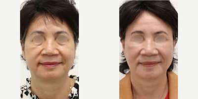 Case 10565 - 55-64 year old woman treated with Facelift, MACS Facelift, SMAS Facelift