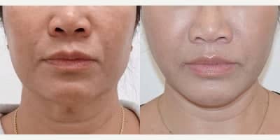 Case 10568 - MACS Facelift, Facelift San Francisco, L Plastic Surgery by Charles K Lee