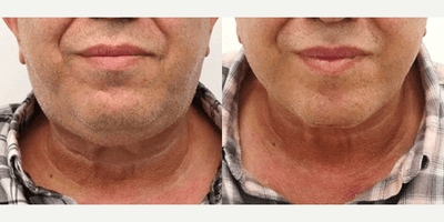 Case 10570 - MACS Facelift and Neck Platysmaplasty
