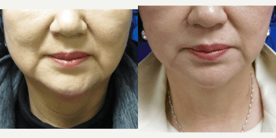 Case 10581 - women treated with MACS Facelift