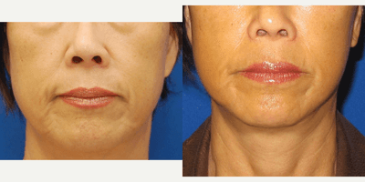 Case 10582 - 45-54 year old woman treated with MACS Facelift