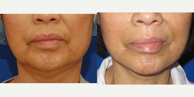Case 10583 - 45-54 year old woman treated with MACS Facelift