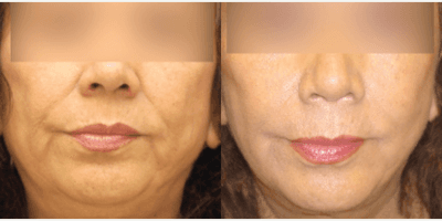 Case 10584 - 45-54 year old woman treated with MACS Facelift