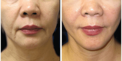 Case 10585 - 45-54 year old woman treated with MACS Facelift