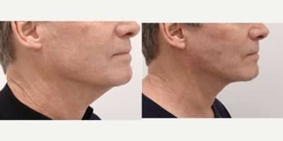 Case 10612 - 45-54 year old man treated with Facelift, MACS Facelift