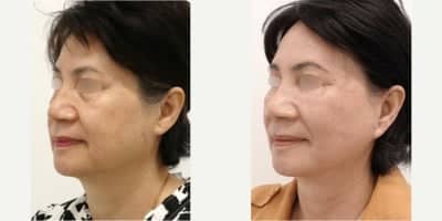 Case 10616 - 55-64 year old woman treated with Facelift, SMAS Facelift, MACS Facelift