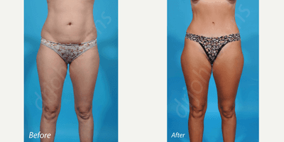 Case 10617 - 35-44 year old woman treated with Liposculpture