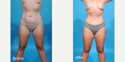 Case 10620 - 35-44 year old woman treated with Liposculpture