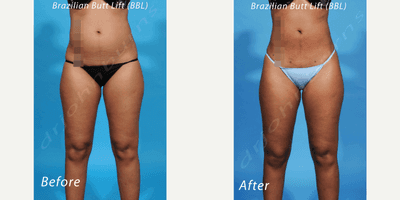 Case 10622 - 35-44 year old woman treated with Liposculpture
