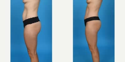 Case 10623 - 35-44 year old woman treated with Abdominal Etching, Diastasis Recti Repair, Drainless Tummy Tuck, Liposculpture, Liposuction, M