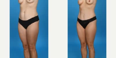 Case 10625 - 35-44 year old woman treated with Abdominal Etching, Diastasis Recti Repair, Drainless Tummy Tuck, Liposculpture, Liposuction, M