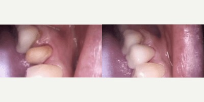 Case 10737 - Patient treated with Dental Crown