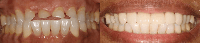 Case 10739 - 45-54 year old woman treated with Dental Crown