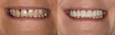 Case 10741 - 45-54 year old woman treated with Dental Crown