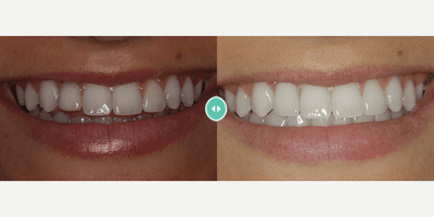 Case 10837 - Woman treated with Dental Implants