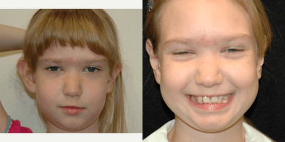 Case 11054 - 17 or under year old woman treated with Ear Surgery