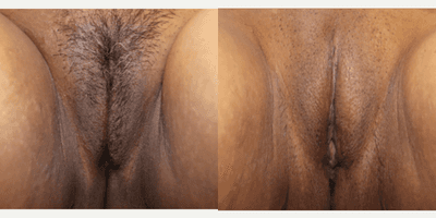 Case 11178 - Woman treated with CO2 Laser