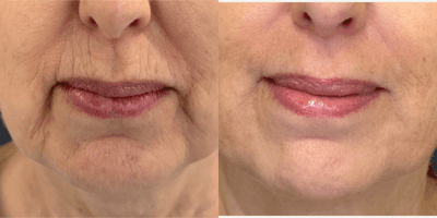 Case 11291 - 55-64 year old woman treated with Microneedling RF, Microneedling
