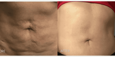 Case 11292 - 45-54 year old woman treated with Secret Pro Radiofrequency Microneedling and CO2