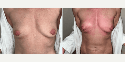 Case 11295 - Woman treated with Microneedling, PRP Injections, for Breast Enhancement