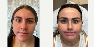 Case 11296 - PERIORAL ACNE SCAR JOURNEY