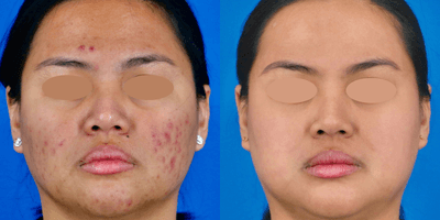 Case 11299 - 25-34 year old woman treated with Accutane, IPL, Skin Tightening, Skin Rejuvenation, Chemical Peel, Microneedling