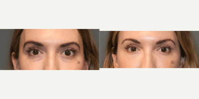 Case 11329 - Woman treated with Microneedling