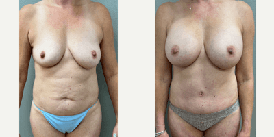 Case 11370 - 45-54 year old woman treated with Mommy Makeover