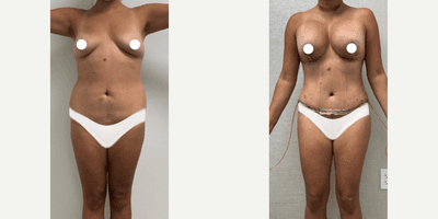 Case 11371 - Woman treated with Mommy Makeover