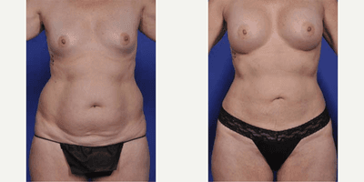 Case 11374 - Woman treated with Mommy Makeover