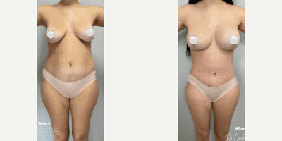 Case 11375 - Woman treated with Mommy Makeover