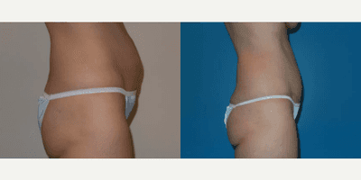 Case 1147 - Woman treated with Tummy Tuck