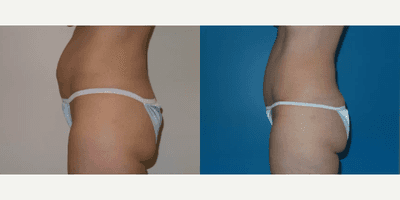 Case 1148 - Woman treated with Tummy Tuck